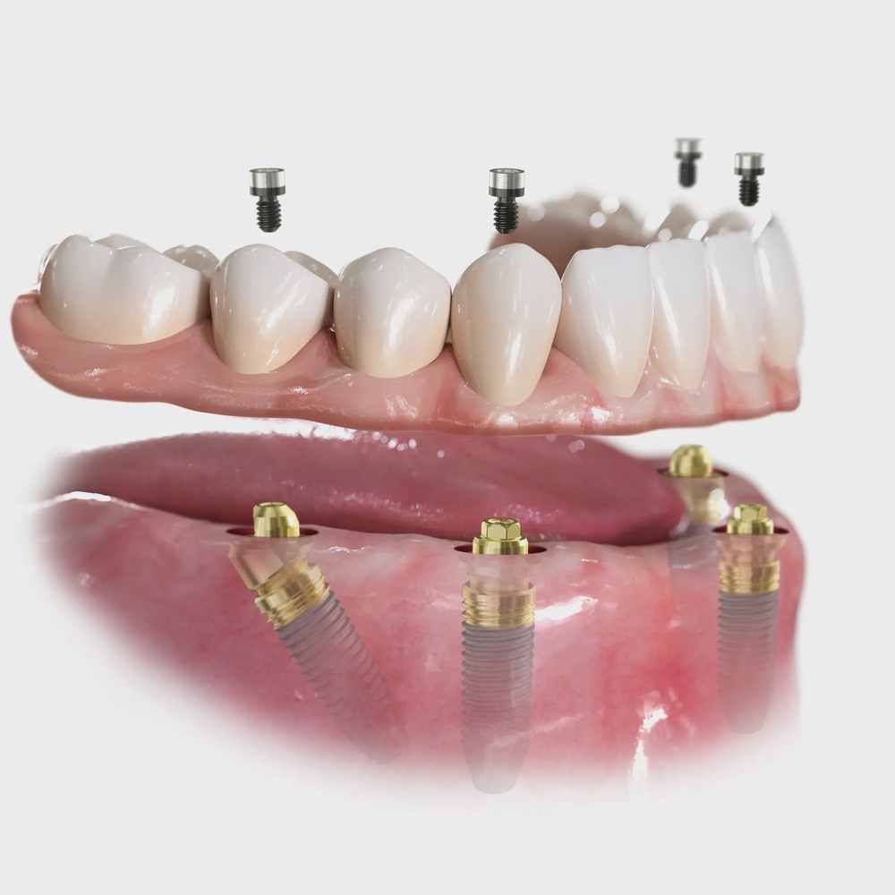 Протезирование на имплантатах